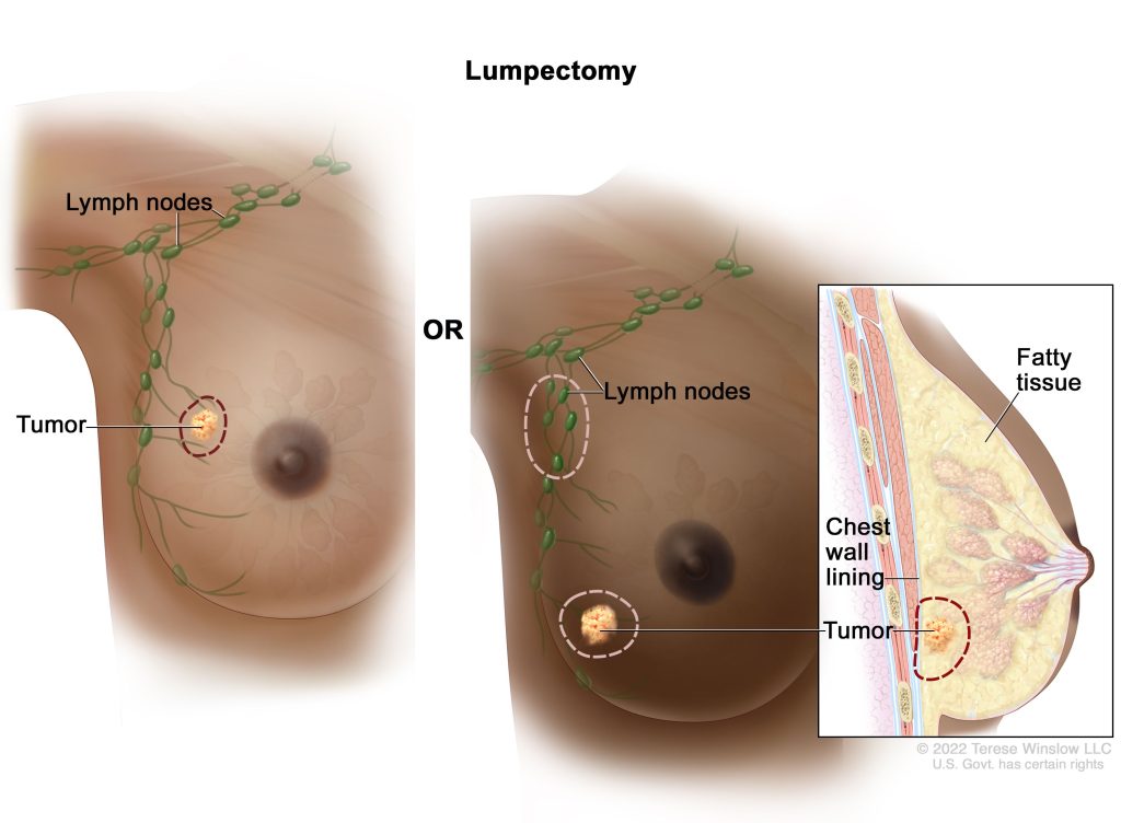 Treatment for Breast Cancer