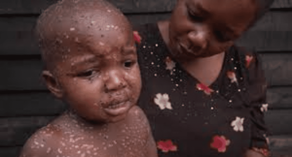 Mpox Outbreak in Congo